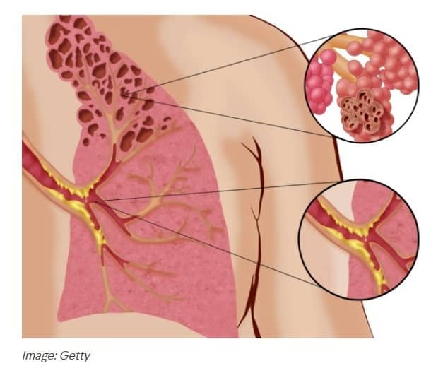 Medical illustration of damaged lung airways linked to popcorn lung.